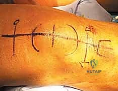 تثبيت الوتر في صابونة الركبة بدقة جراحية عالية