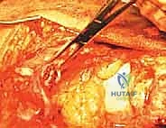 تأثير الأمراض المزمنة على أوتار الركبة