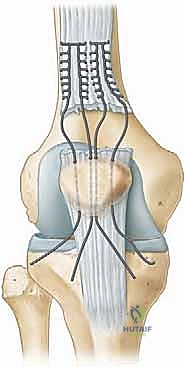 الأعراض السريرية لتمزق الوتر الرباعي والفجوة الملموسة