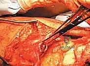 صورة توضيحية لـ إصلاح تمزق الوتر الرباعي للركبة: دليل شامل للمرضى مع الأستاذ الدكتور محمد هطيف في صنعاء