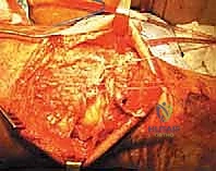 أسباب وعوامل خطر تمزق الوتر الرباعي