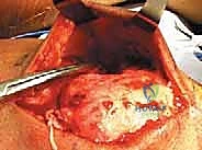 صورة توضيحية لـ إصلاح تمزق الوتر الرباعي للركبة: دليل شامل للمرضى مع الأستاذ الدكتور محمد هطيف في صنعاء