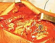 صورة توضيحية لـ إصلاح تمزق الوتر الرباعي للركبة: دليل شامل للمرضى مع الأستاذ الدكتور محمد هطيف في صنعاء