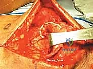 التشريح الوظيفي للوتر الرباعي وعضلات الفخذ