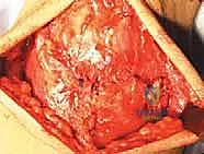 صورة توضيحية لـ إصلاح تمزق الوتر الرباعي للركبة: دليل شامل للمرضى مع الأستاذ الدكتور محمد هطيف في صنعاء