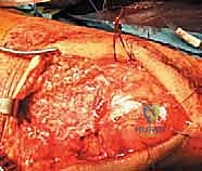 تجهيز المريض للعملية الجراحية في غرفة العمليات