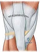 خيارات العلاج لتمزق الوتر الرباعي