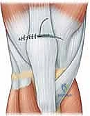 صورة توضيحية لـ إصلاح تمزق الوتر الرباعي للركبة: دليل شامل للمرضى مع الأستاذ الدكتور محمد هطيف في صنعاء