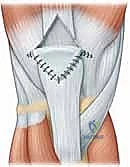 Illustration of quadriceps tendon ruptures - Dr. Mohammed Hutaif