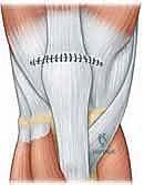 صورة توضيحية لـ إصلاح تمزق الوتر الرباعي للركبة: دليل شامل للمرضى مع الأستاذ الدكتور محمد هطيف في صنعاء