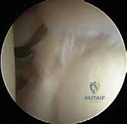 صورة توضيحية لـ إصلاح تمزق الشفا العلوي (SLAP) بالمنظار: دليل شامل للمرضى مع الأستاذ الدكتور محمد هطيف