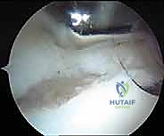 التشريح الدقيق لمفصل الكتف والشفا الحقاني