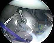 صورة توضيحية لـ إصلاح تمزق الشفا العلوي (SLAP) بالمنظار: دليل شامل للمرضى مع الأستاذ الدكتور محمد هطيف