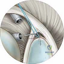 صورة توضيحية لـ إصلاح تمزق الشفا العلوي (SLAP) بالمنظار: دليل شامل للمرضى مع الأستاذ الدكتور محمد هطيف