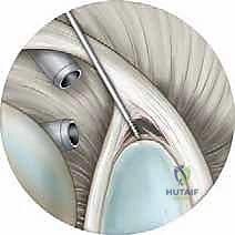 التشخيص والاختبارات السريرية لتمزق SLAP