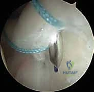 صورة توضيحية لـ إصلاح تمزق الشفا العلوي (SLAP) بالمنظار: دليل شامل للمرضى مع الأستاذ الدكتور محمد هطيف