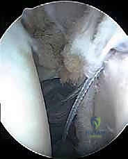 صورة توضيحية لـ إصلاح تمزق الشفا العلوي (SLAP) بالمنظار: دليل شامل للمرضى مع الأستاذ الدكتور محمد هطيف