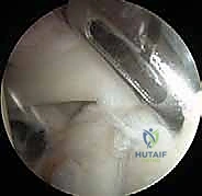 أنواع تمزقات الشفا العلوي وتصنيف سنايدر