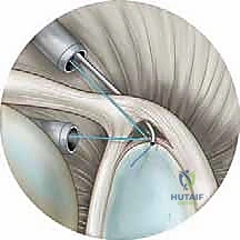 إصلاح تمزق الشفا العلوي (SLAP) بالمنظار: دليل شامل للمرضى مع الأستاذ الدكتور محمد هطيف