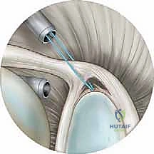 Illustration of superior labral slap - Dr. Mohammed Hutaif