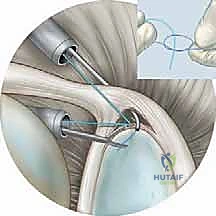 صورة توضيحية لـ إصلاح تمزق الشفا العلوي (SLAP) بالمنظار: دليل شامل للمرضى مع الأستاذ الدكتور محمد هطيف