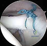 صورة طبية: إصلاح تمزق الشفا العلوي (SLAP) بالمنظار: دليل شامل للمرضى مع الأستاذ الدكتور محمد هطيف