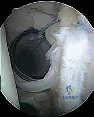 صورة توضيحية لـ إصلاح تمزق الشفا العلوي (SLAP) بالمنظار: دليل شامل للمرضى مع الأستاذ الدكتور محمد هطيف