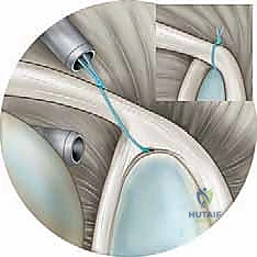 صورة طبية: إصلاح تمزق الشفا العلوي (SLAP) بالمنظار: دليل شامل للمرضى مع الأستاذ الدكتور محمد هطيف