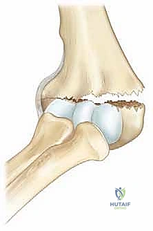 FIG 1 • Reduction of a posteromedially displaced supracondylar fracture of the humerus. Pronation of the forearm closes the hinge and aids in reduction.