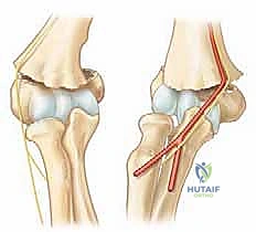 تشريح كسر عظم العضد فوق اللقمة عند الأطفال
