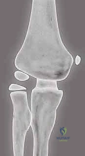 صورة توضيحية لـ كسر عظم العضد فوق اللقمة عند الأطفال الرد المغلق والتثبيت بالأسلاك مع الأستاذ الدكتور محمد هطيف