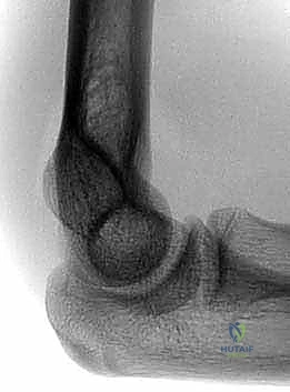 مراكز النمو العظمي في كوع الطفل