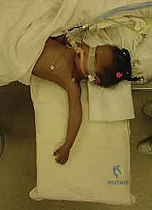 تصنيف غارتلاند لكسور الكوع