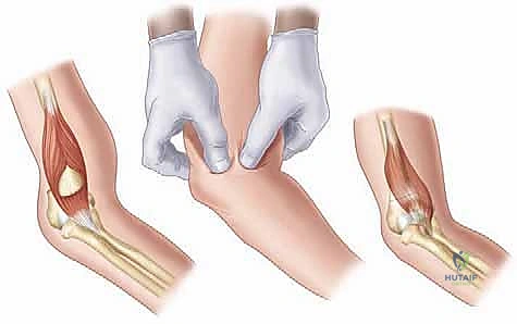 الأشعة السينية لكسر فوق اللقمة