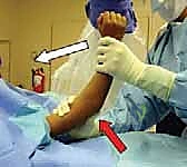 التحضير للرد المغلق والتثبيت بالأسلاك