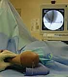 صورة توضيحية لـ كسر عظم العضد فوق اللقمة عند الأطفال الرد المغلق والتثبيت بالأسلاك مع الأستاذ الدكتور محمد هطيف