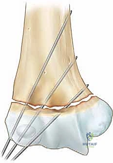 صورة توضيحية لـ كسر عظم العضد فوق اللقمة عند الأطفال الرد المغلق والتثبيت بالأسلاك مع الأستاذ الدكتور محمد هطيف