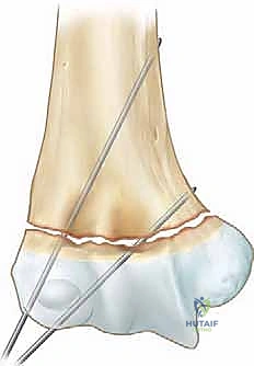 صورة توضيحية لـ كسر عظم العضد فوق اللقمة عند الأطفال الرد المغلق والتثبيت بالأسلاك مع الأستاذ الدكتور محمد هطيف