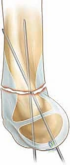 كسر عظم العضد فوق اللقمة عند الأطفال الرد المغلق والتثبيت بالأسلاك مع الأستاذ الدكتور محمد هطيف