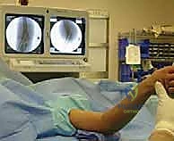 صورة طبية: كسر عظم العضد فوق اللقمة عند الأطفال الرد المغلق والتثبيت بالأسلاك مع الأستاذ الدكتور محمد هطيف