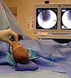 صورة طبية: كسر عظم العضد فوق اللقمة عند الأطفال الرد المغلق والتثبيت بالأسلاك مع الأستاذ الدكتور محمد هطيف