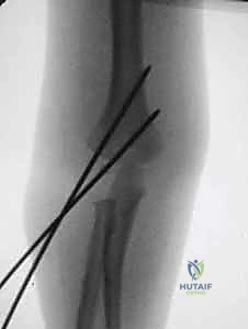 صورة توضيحية لـ كسر عظم العضد فوق اللقمة عند الأطفال الرد المغلق والتثبيت بالأسلاك مع الأستاذ الدكتور محمد هطيف