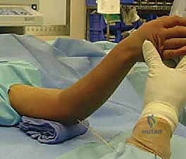 صورة توضيحية لـ كسر عظم العضد فوق اللقمة عند الأطفال الرد المغلق والتثبيت بالأسلاك مع الأستاذ الدكتور محمد هطيف