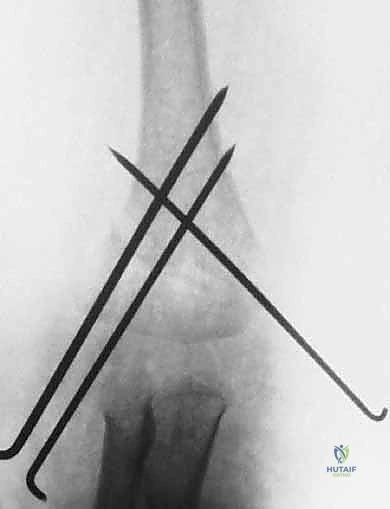 صورة توضيحية لـ كسر عظم العضد فوق اللقمة عند الأطفال الرد المغلق والتثبيت بالأسلاك مع الأستاذ الدكتور محمد هطيف