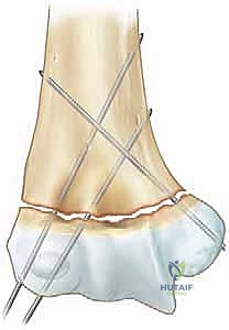 صورة طبية: كسر عظم العضد فوق اللقمة عند الأطفال الرد المغلق والتثبيت بالأسلاك مع الأستاذ الدكتور محمد هطيف