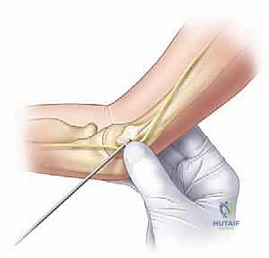 صورة طبية: كسر عظم العضد فوق اللقمة عند الأطفال الرد المغلق والتثبيت بالأسلاك مع الأستاذ الدكتور محمد هطيف
