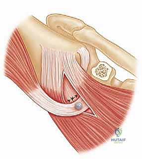 تثبيت العظم باستخدام براغي التيتانيوم