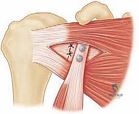 خطوات فصل الناتئ الغرابي