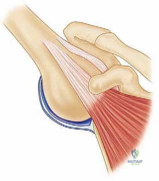 Latarjet Glenoid Reconstruction: A Masterclass in Anterior Shoulder Instability with Bone Loss