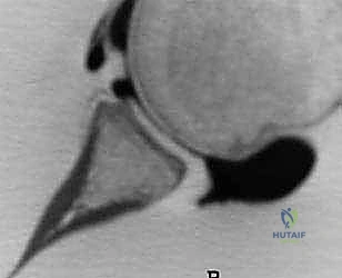 تشريح مفصل الكتف وتأثير الخلع المتكرر